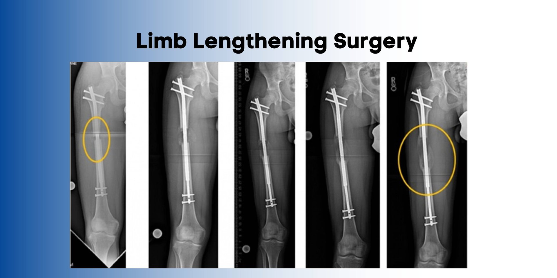 Limb Lengthening Surgery in India Know the Best Doctors