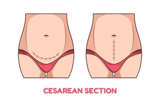C-Section