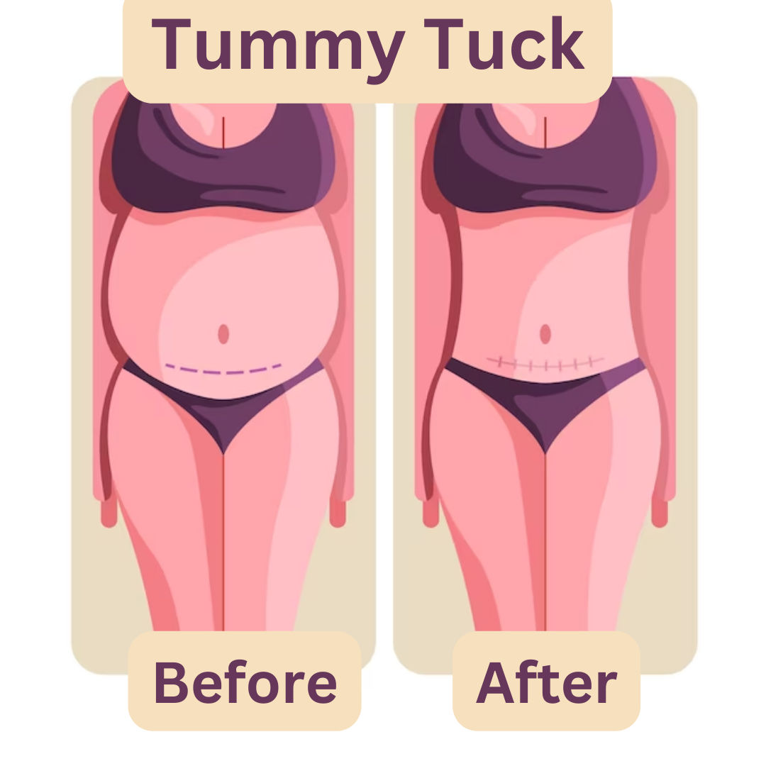 before/after tummy tuck dubai
