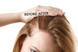 Forehead reduction before/after
