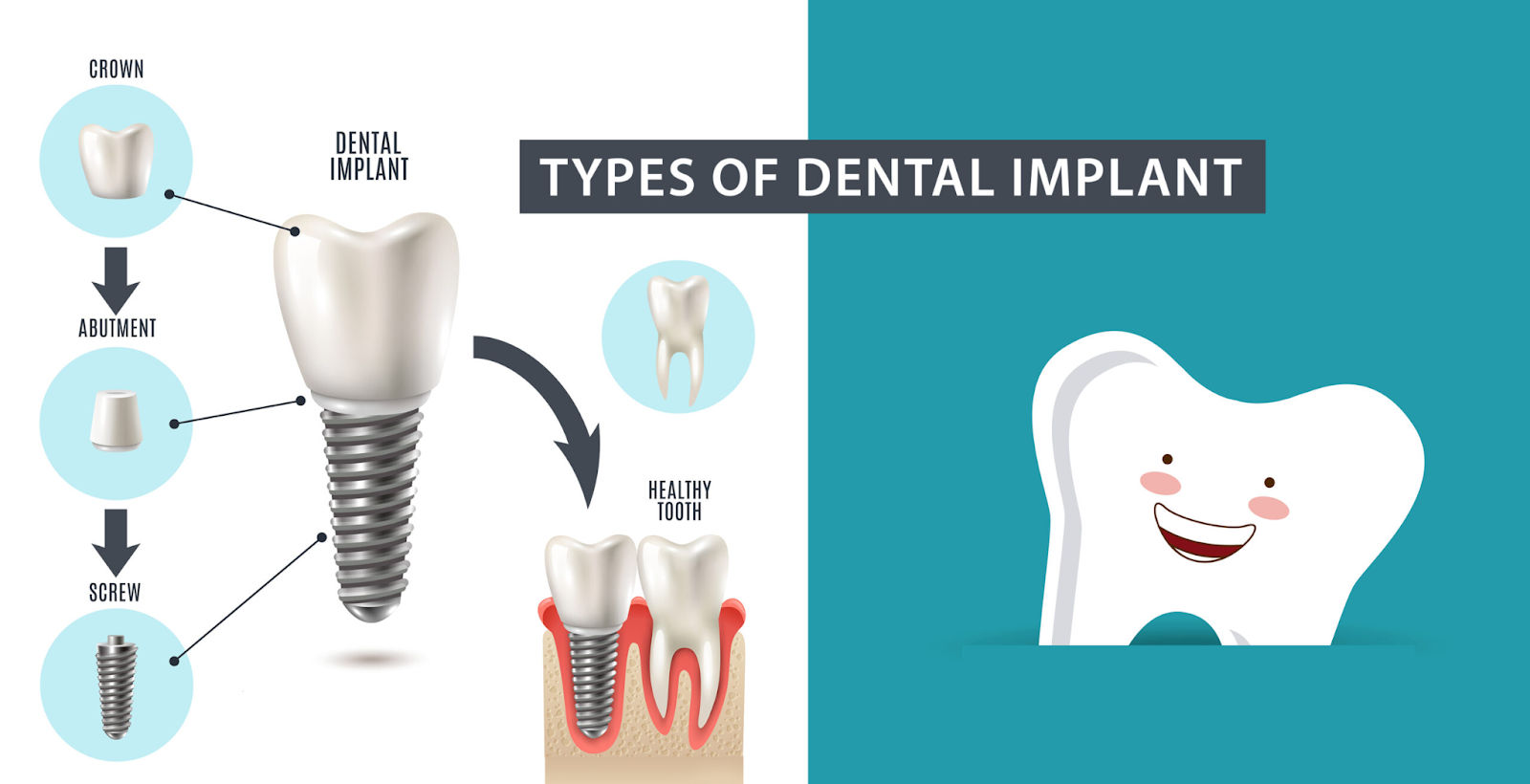 Types of dental implant