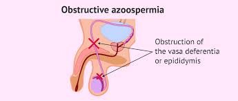 Obstructive Azoospermia - Causes ...