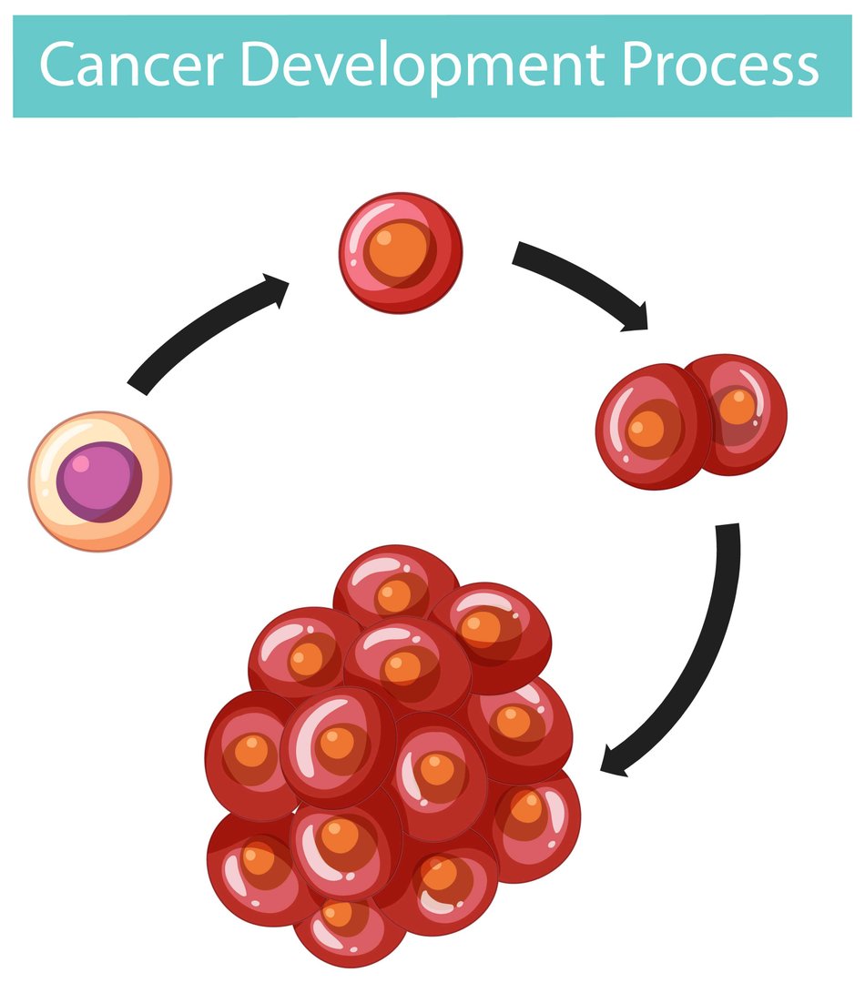 Acute Myeloid Leukemia