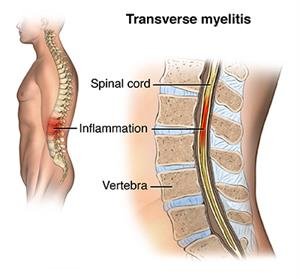 Definition of Transverse Myelitis