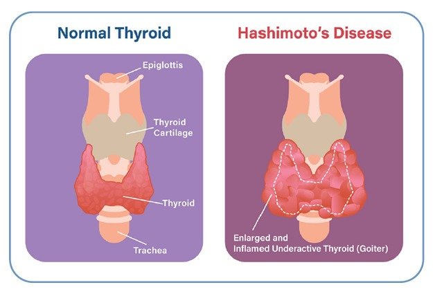 Hashimoto's disease