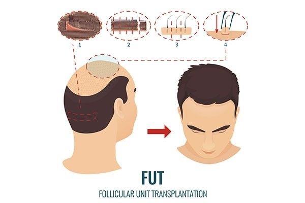 What is FUT Hair Transplant?