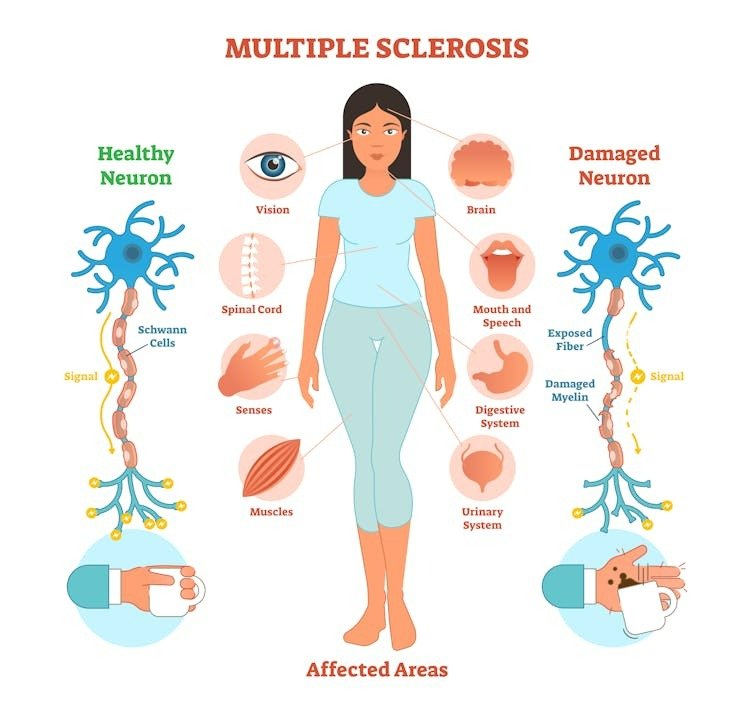 Multiple sclerosis