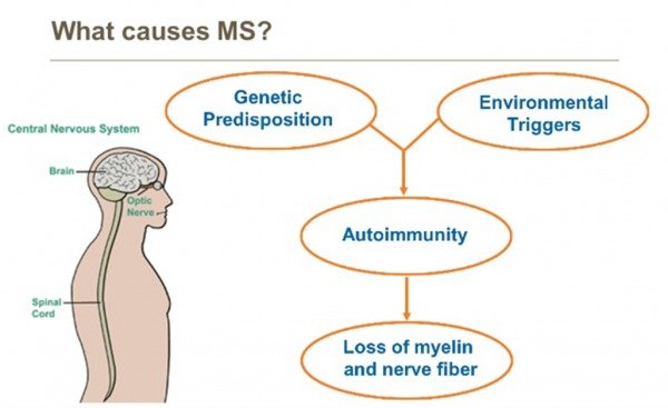 Causes of Multiple Sclerosis