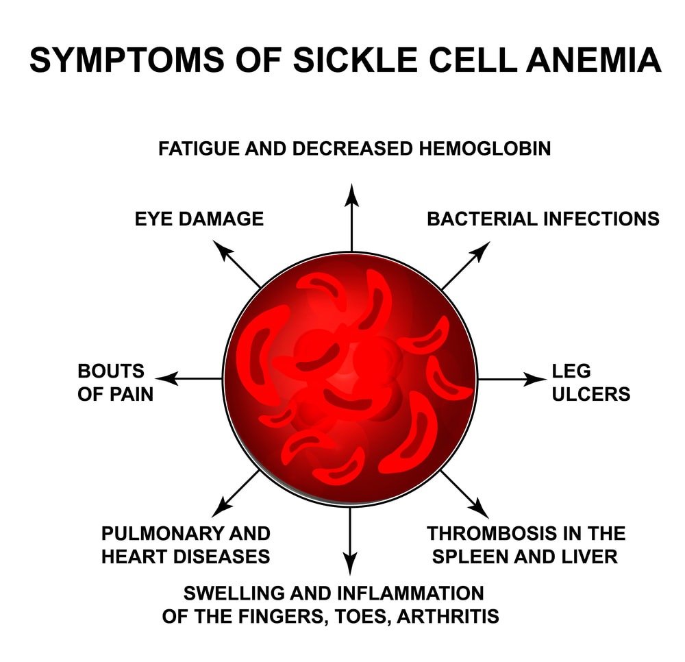 Symptoms of Sickle cell anemia