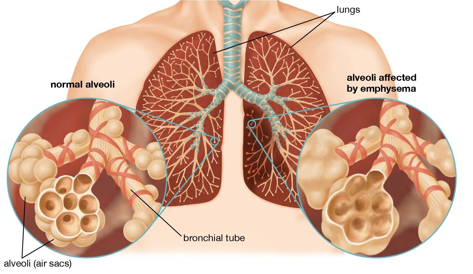 Emphysema