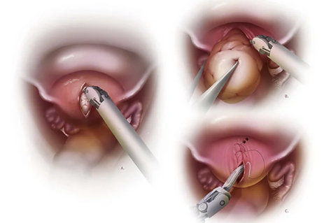 Is pregnancy after myomectomy high risk?