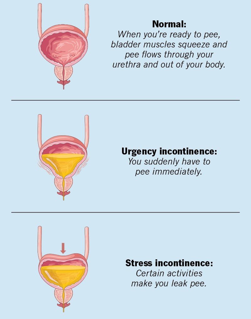 Leaky Bladder After Hysterectomy