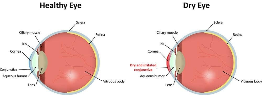 Healthy eye vs dry eye