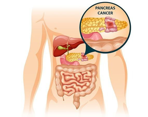 What is Pancreatic Cancer