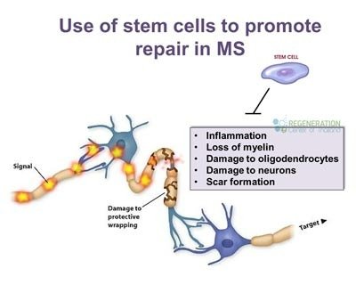 How Stem Cell works for Multiple Sclerosis