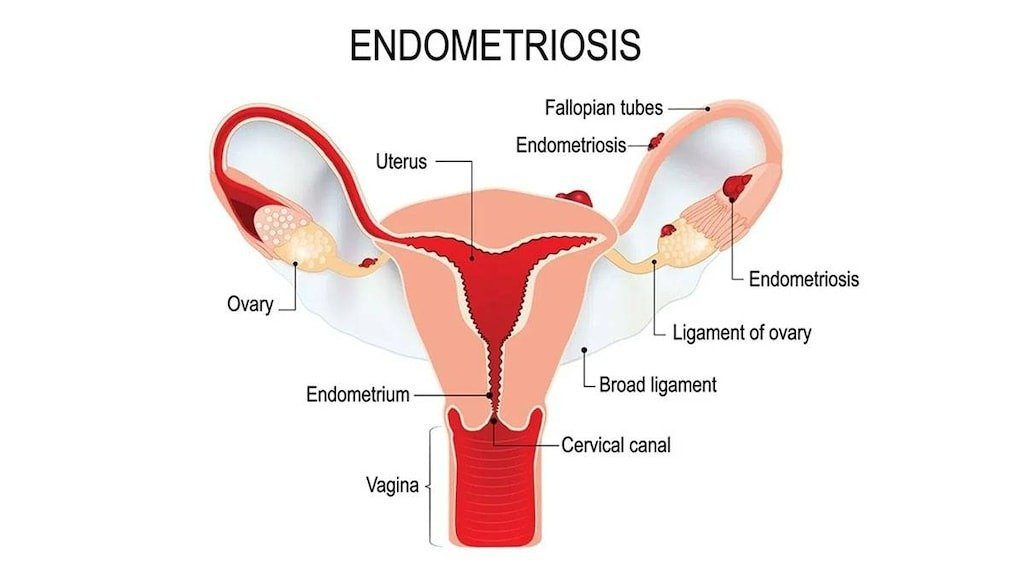 Endometriosis