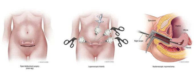 Different types of myomectomy