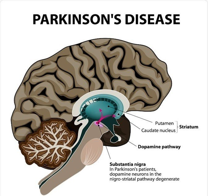 Parkinson's Disease