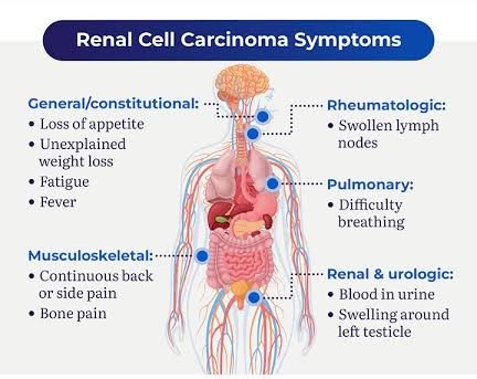 Symptoms of Renal Cancer Metastasis to the Lungs