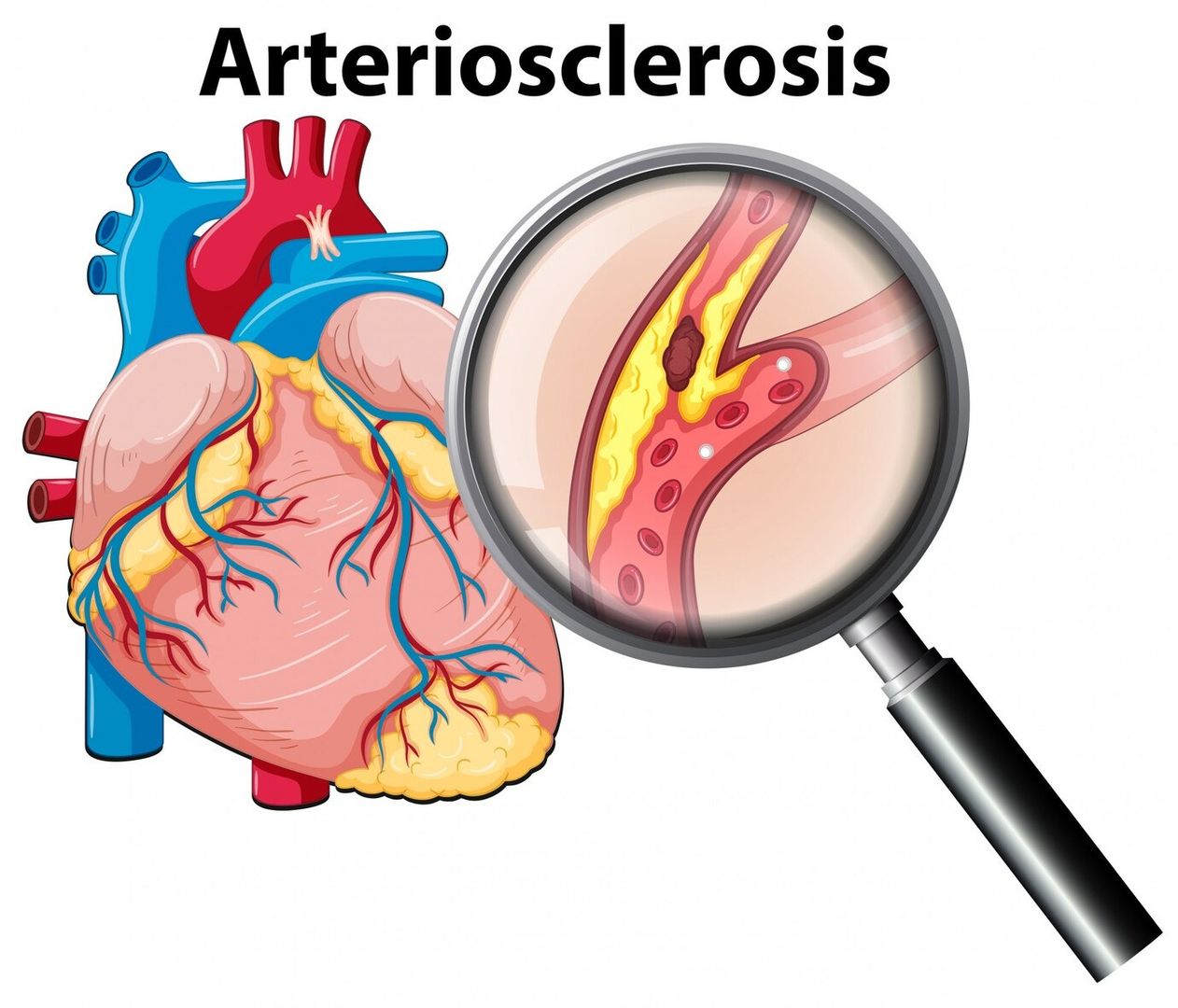 Hypertensive-Arteriosclerotic Cardiovascular Disease