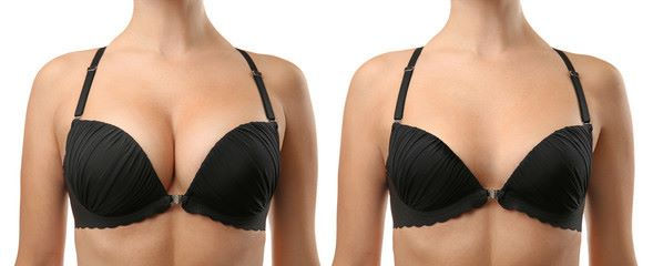 results of breast reduction dubai