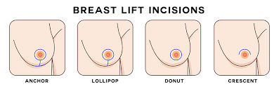 Types of breast lift in dubai
