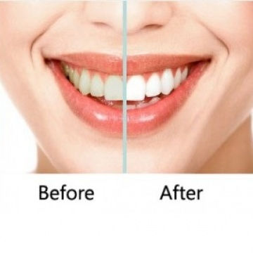 before/after teeth whitening dubai