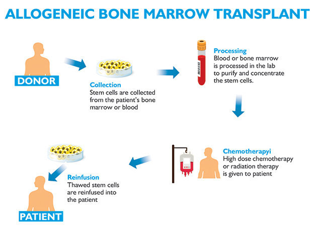 allogeneic bone marrow transplant