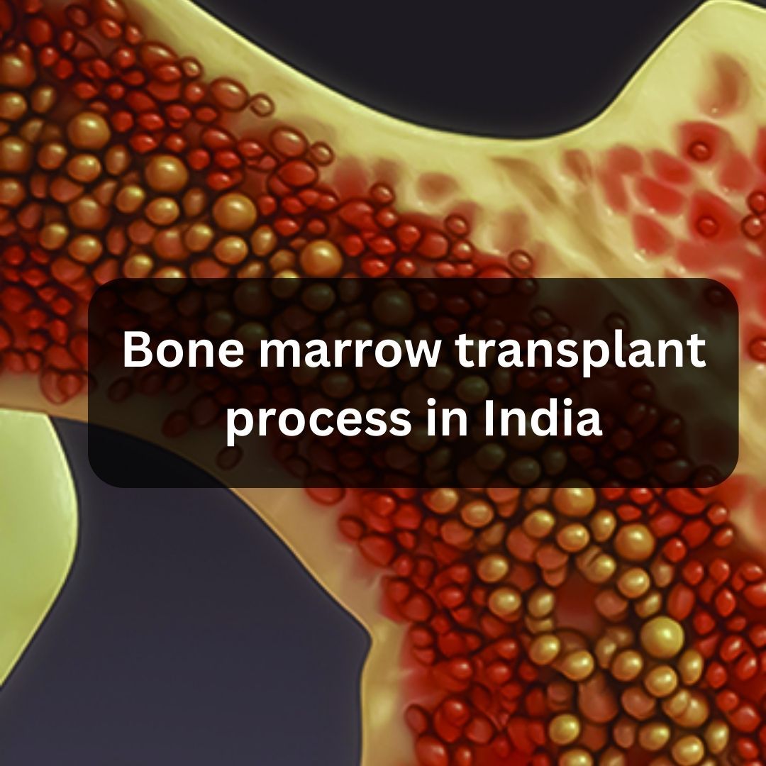 Bone Marrow Transplant Process 