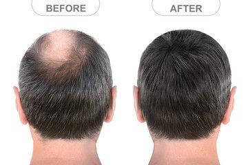 hair transplant before/after