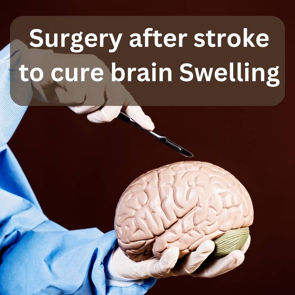 Surgery after brain stroke to cure brain Swelling