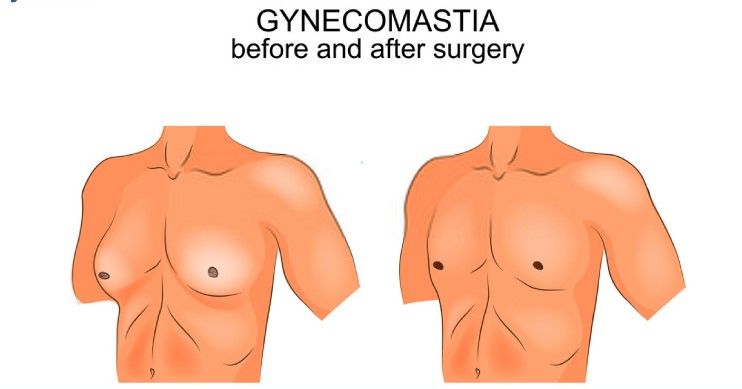 What do breasts (gynecomastia) look like on men? - Quora