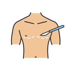 gynecomastia surgery