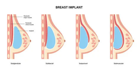 breast implant india