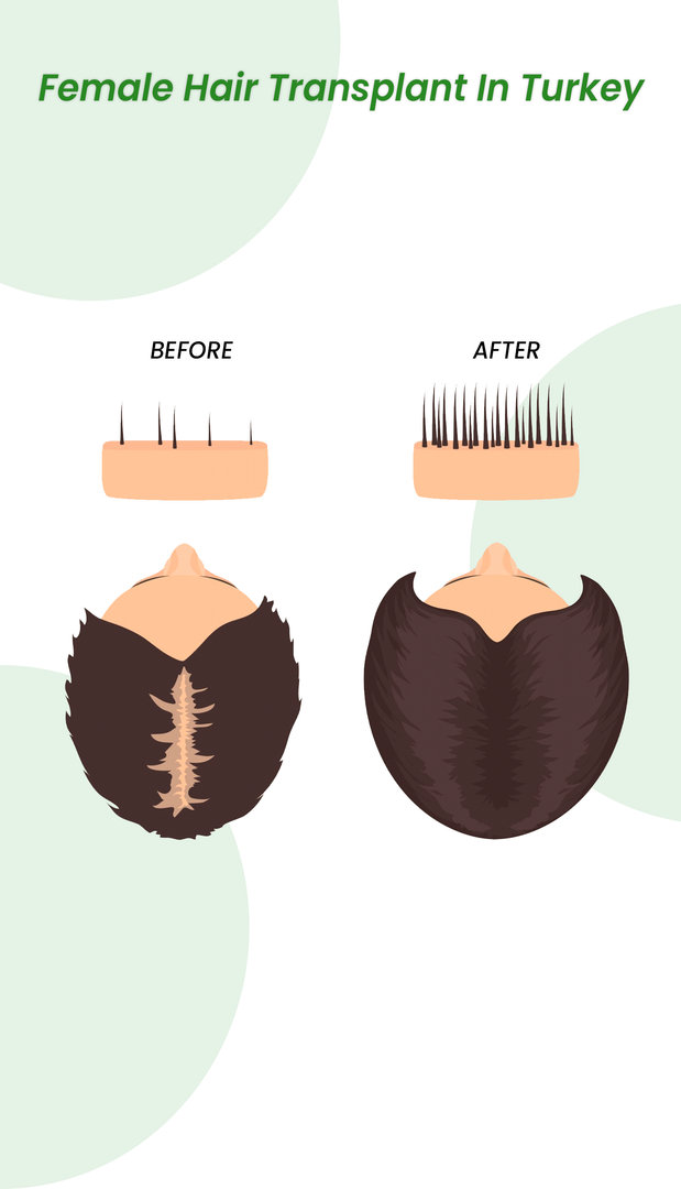 Female hair transplant turkey