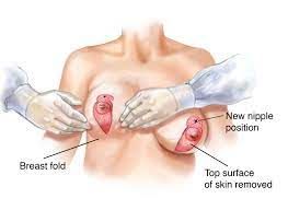 Lolipop breast reduction