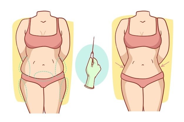 tummy tuck 