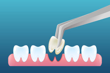 tooth extraction dubai