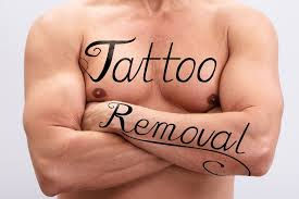 Tattoo removal in dubai