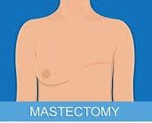 Mastectomy