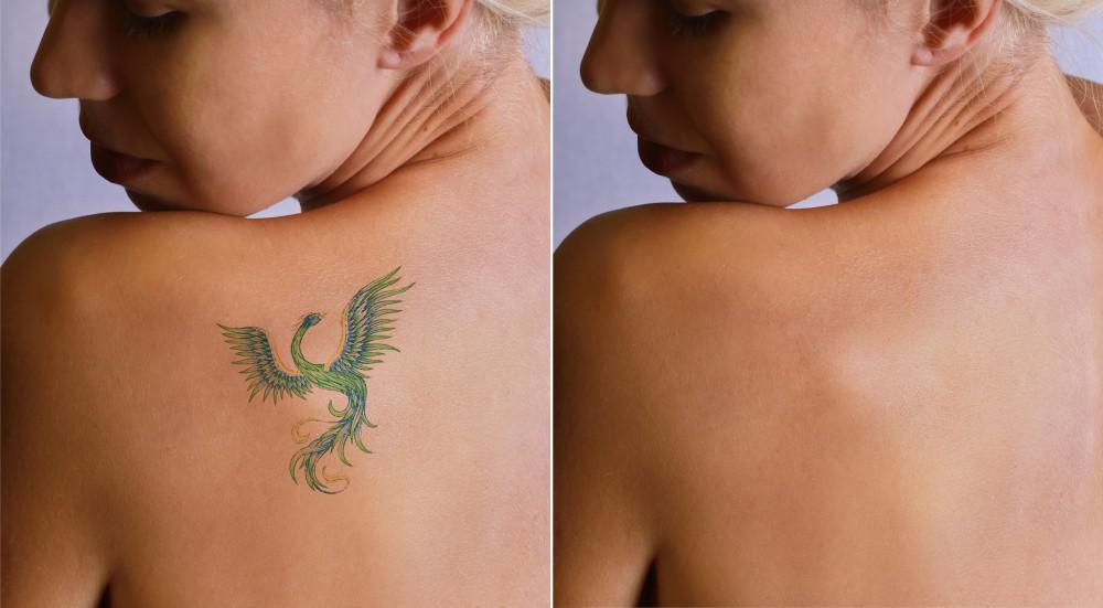Tattoo removal dubai before after