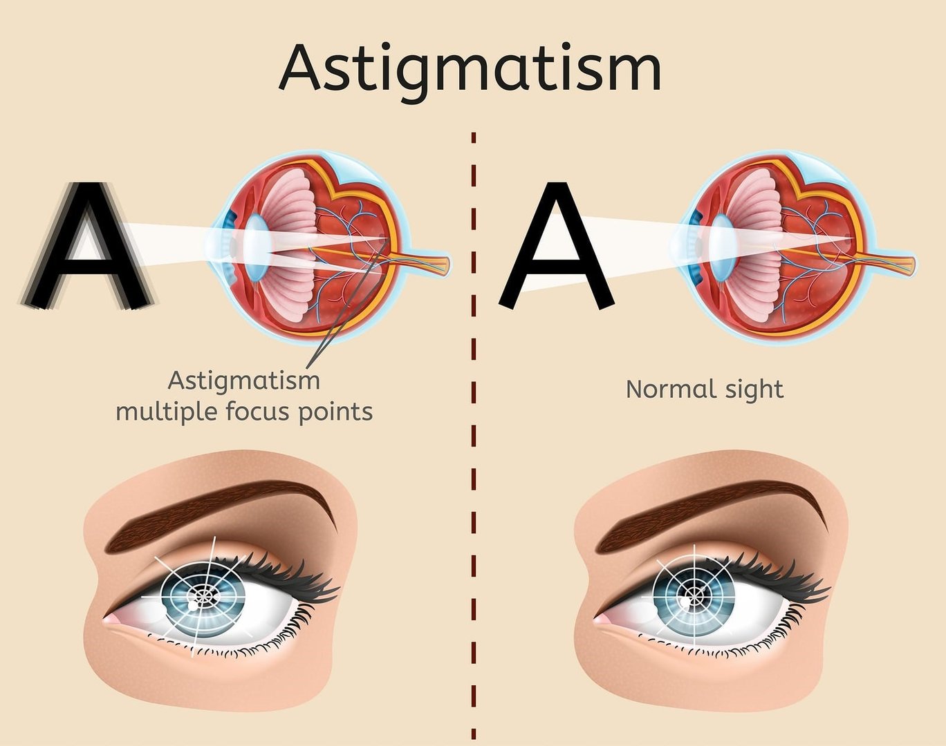 What Are The Two Types Of Astigmatism