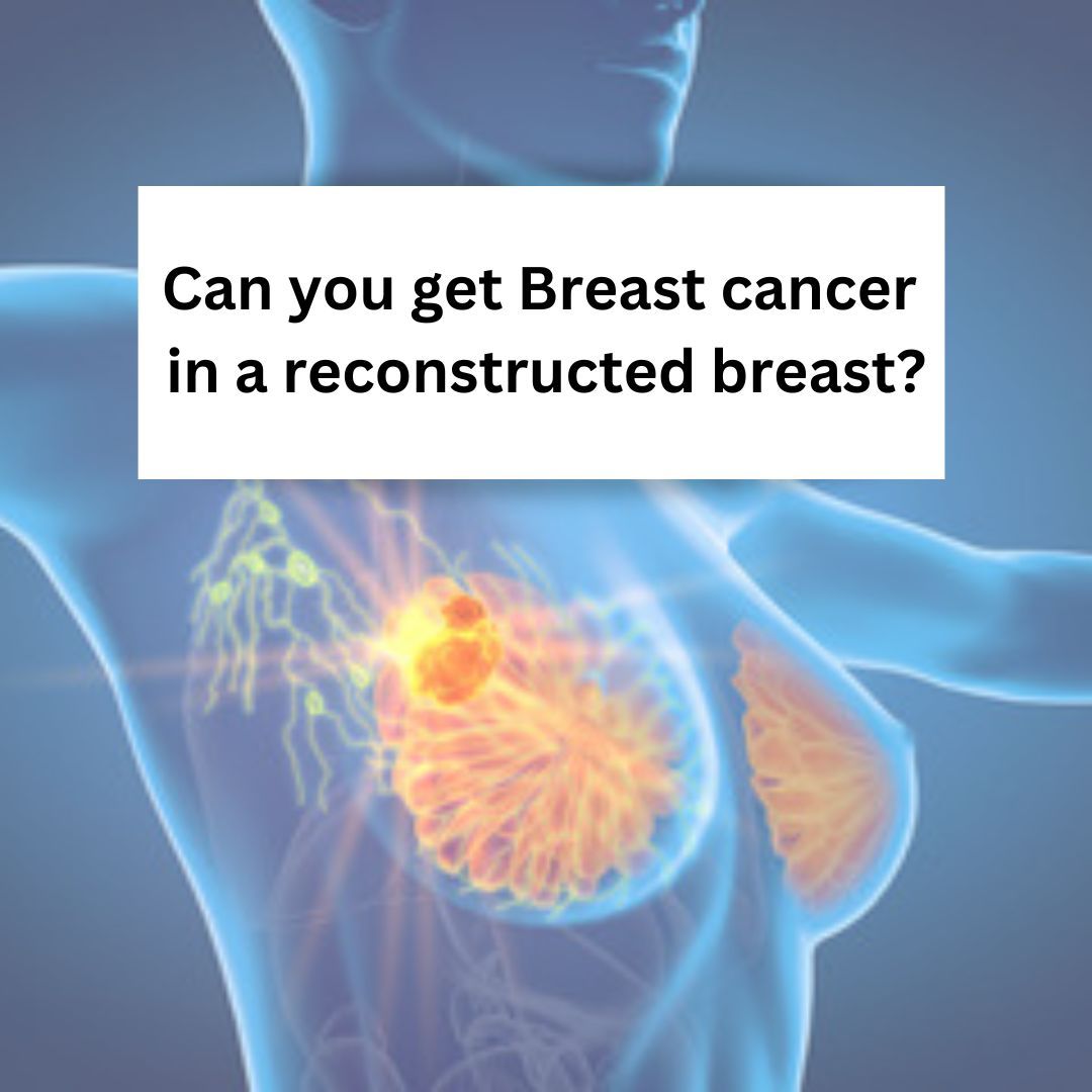 Breast cancer in a reconstructed breast